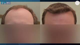 FUE 2991 Fu´s Dr Lupanzula MeDiKemos ENG #hairtransplant