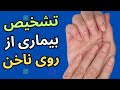 تغییر رنگ ناخن ها را جدی بگیر چون نشانه نوعی بیماریست