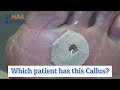 Which patient has the BETTER foot callus? [Callus Tuesday] (2020)