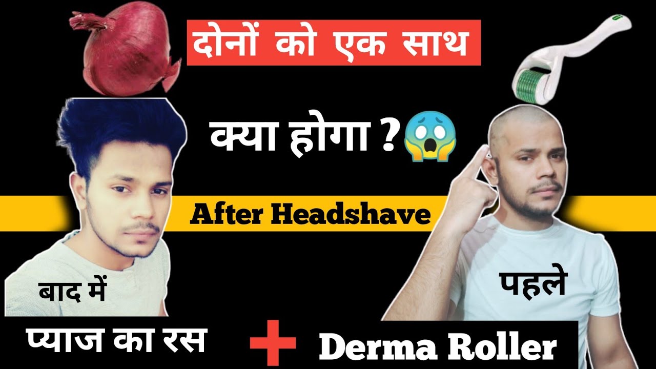 𝗗𝗲𝗿𝗺𝗮 𝗥𝗼𝗹𝗹𝗲𝗿 𝗮𝗻𝗱 𝗢𝗻𝗶𝗼𝗻 𝗝𝘂𝗶𝗰𝗲 𝗳𝗼𝗿 𝗛𝗮𝗶𝗿 𝗚𝗿𝗼𝘄𝘁𝗵डर्मा रोलर और प्याज के रस