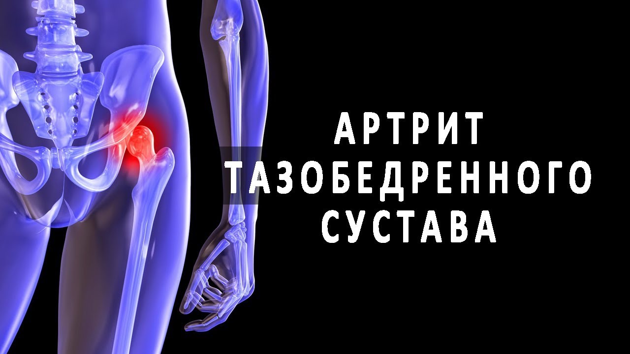 Медицина суставы тазобедренный. Реактивный артрит тазобедренного сустава. Артрит бедренного сустава симптомы. Артрит артроз тазобедренного сустава. Тазобедренный сустав болит.