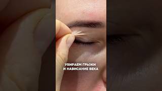 Трансконьюктивальная блефаропластика и пластика верхних век #пластическийхирург