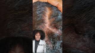 How to Check If Your Hair Follicles Are Dead or Alive – 3 Simple Steps! #hairloss #hairgrowth