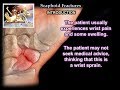 Scaphoid Fractures - Everything You Need To Know - Dr. Nabil Ebraheim