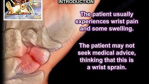 Scaphoid Fractures - Everything You Need To Know - Dr. Nabil Ebraheim