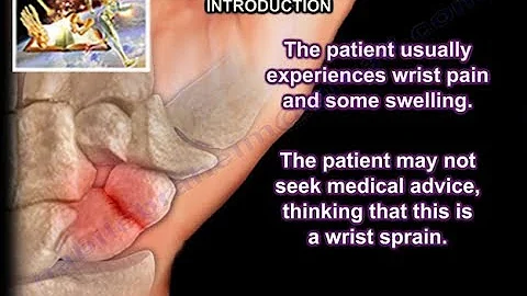 Scaphoid Fractures - Everything You Need To Know - Dr. Nabil Ebraheim