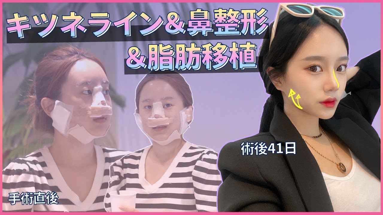 キツネライン+鼻整形+脂肪移植で一気に華やかに✨【エートップ美容整形外科】