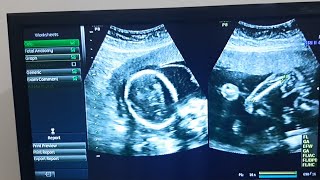 Twins TIFFA SCAN ultrasound|| TIFFA SCAN