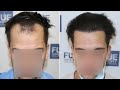 Fue hair transplant 2225 grafts norwood iii by dr juan couto  fuexpert clinic  madrid spain