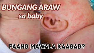 BUNGANG ARAW Home Remedies (Heat Rash Prevention and Treatment) April Eco