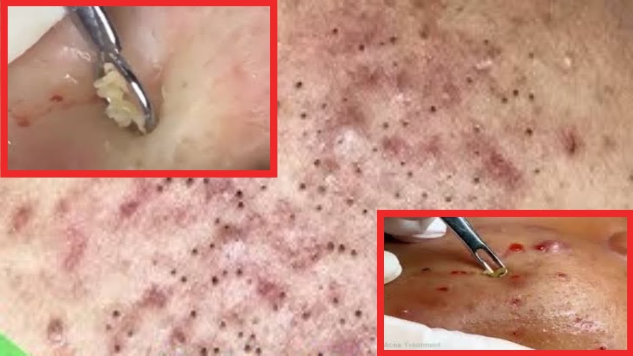 cystic Acne pimples and blachkeads past 2 - YouTube