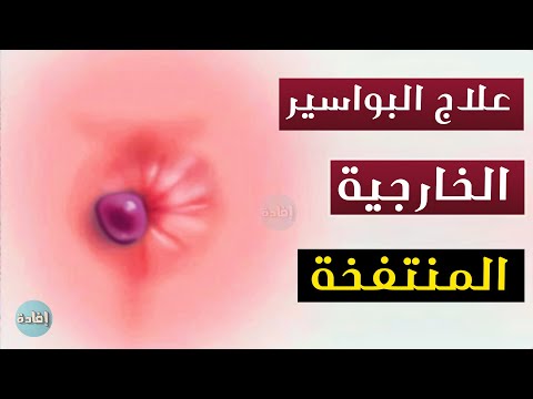 فيديو: كمثرى بواسير