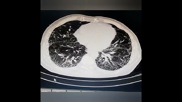 Chest CT : IPF patient with honeycomb