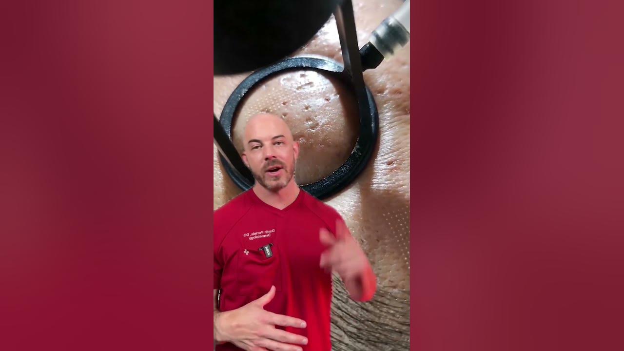 This is what CO2 Laser-ing looks like! (Credit: Omi Aesthetics Devices on TT) #doctor #satisfying