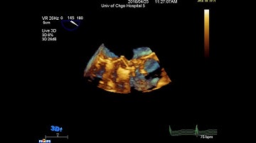 Prosthetic Mitral Valve Obstruction - 3D Echo