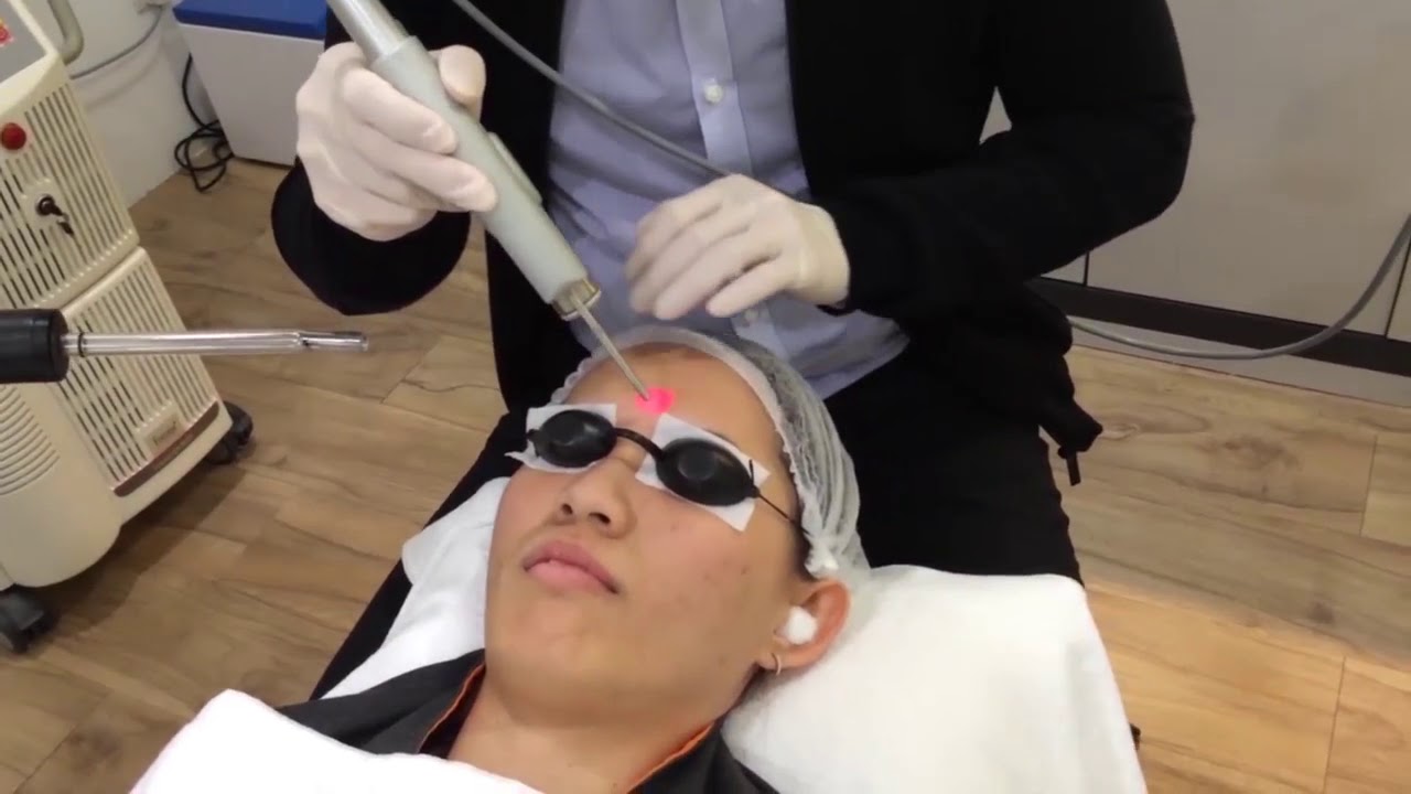 skin thesis 4d tightening laser