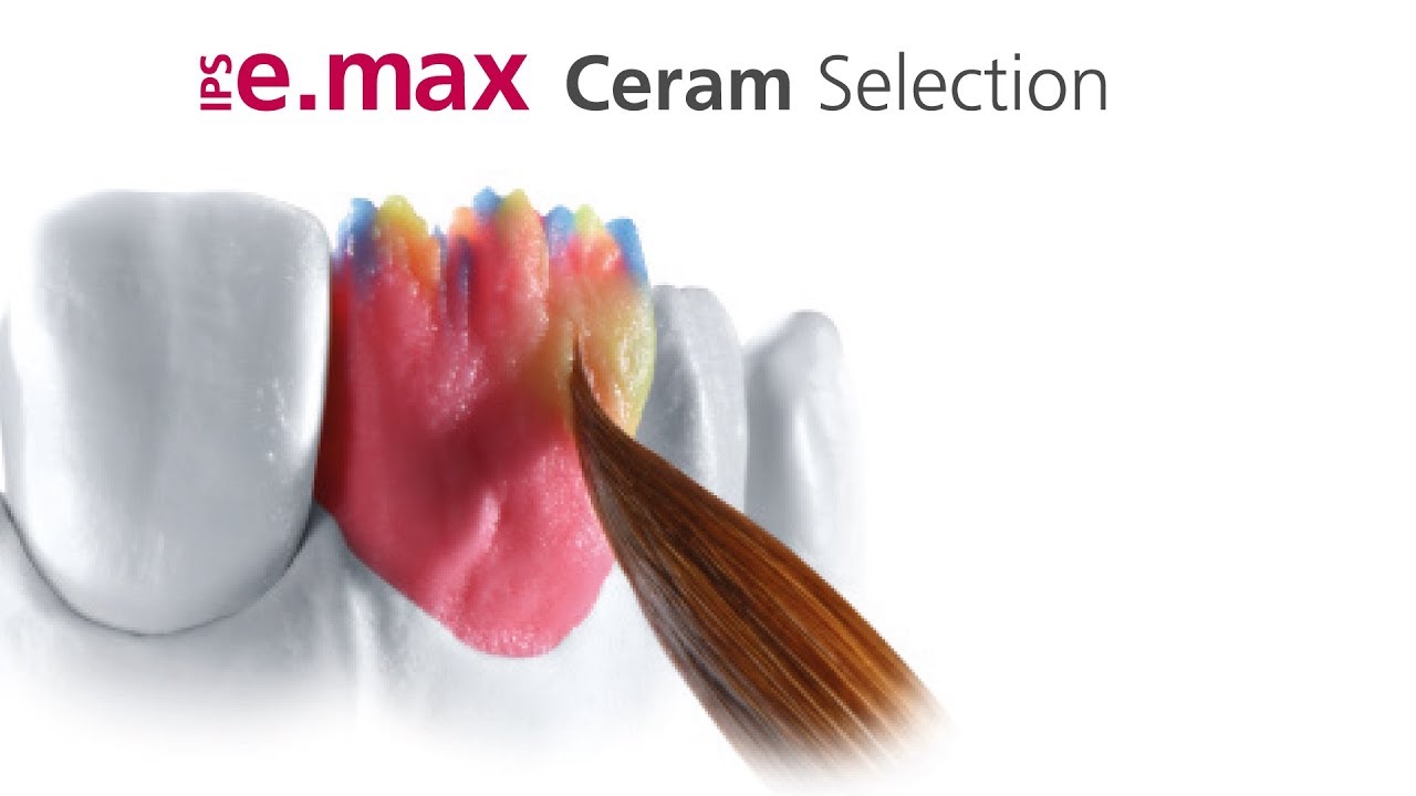 Emax Ingot Selection Chart