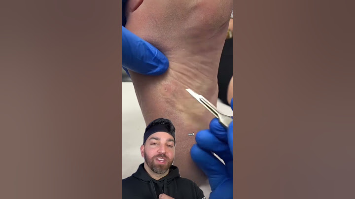 Painful BUMP on the Bottom of the Foot | Doctorly #shorts