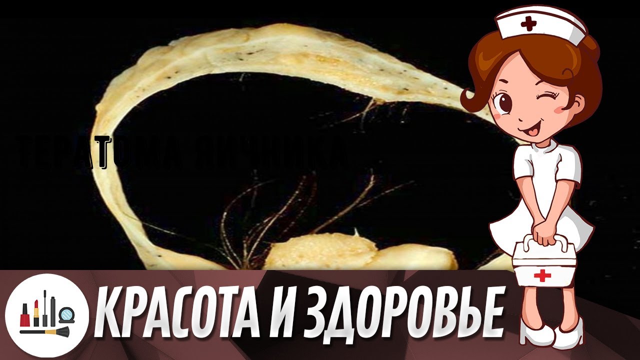 Тератома яичника - YouTube
