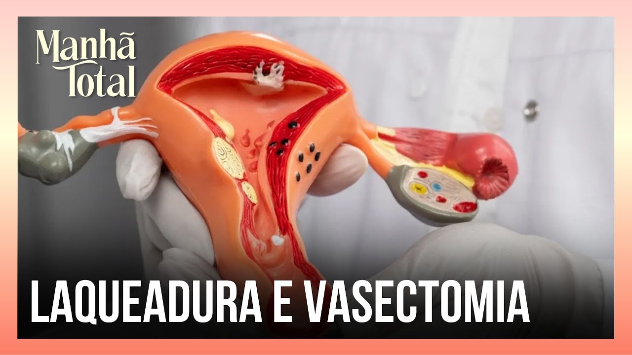 Laqueadura e vasectomia: Saiba mais sobre as novas regras desses ...