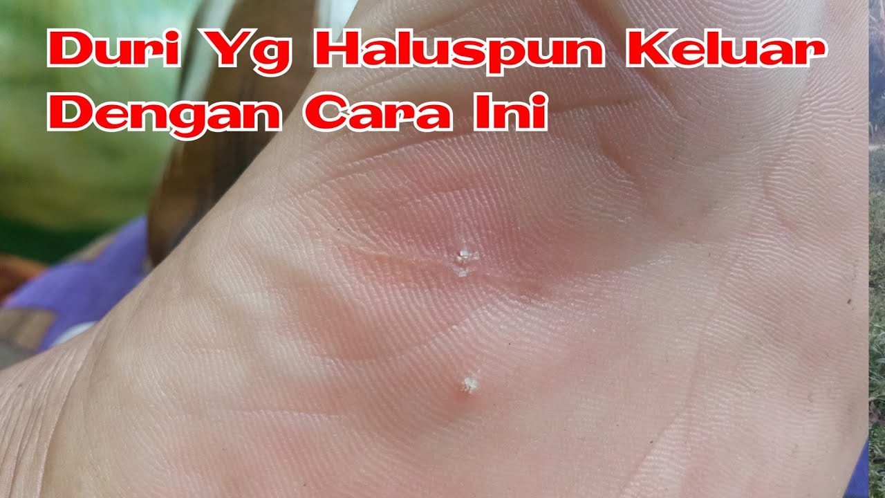 Luar Biasa Duri Di Kaki Langsung Keluar Dengan Cara Ini Youtube