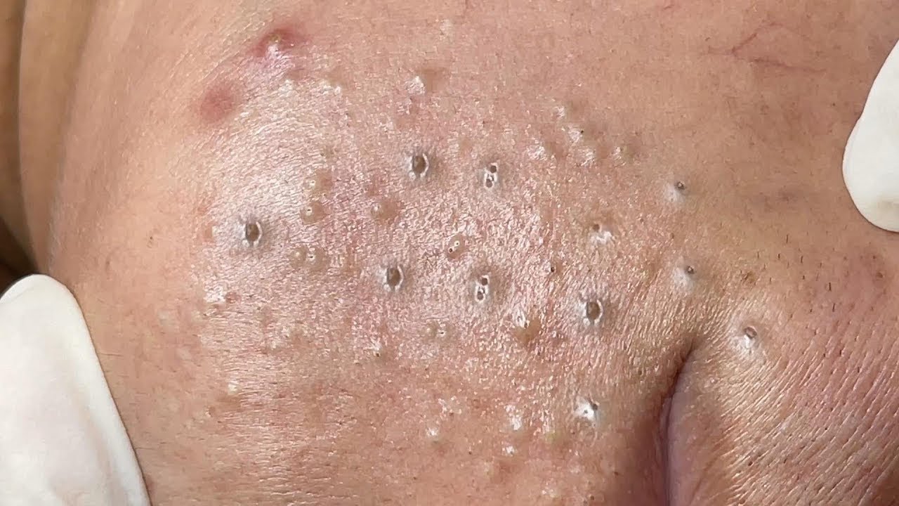 Remove Blackheads and Hidden Acne At Loan Nguyen Spa 231 YouTube