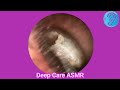 ASMR Ear Cleaning | Guaranteed Tingles and Instant Relaxation