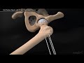 Hip Fracture Repair with 6.7 mm Cannulated Screws