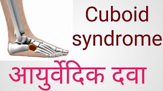 cuboid syndrome का आयुर्वेदिक इलाज।ramban nuskhe।cuboid syndrome treatment।