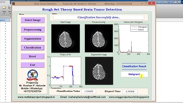 Brain Tumor Detection using Rough Set Theory Matlab Project code