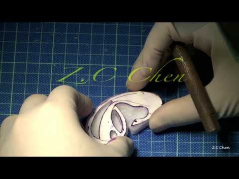Ear Reconstruction. Medpor, Dr. Z.C Chen (陳潤茺醫師）, CGMH, Taiwan