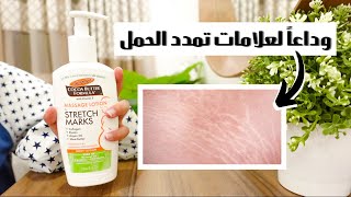 كيف تخلصت من علامات التمدد اثناء الحمل 🤰🏻