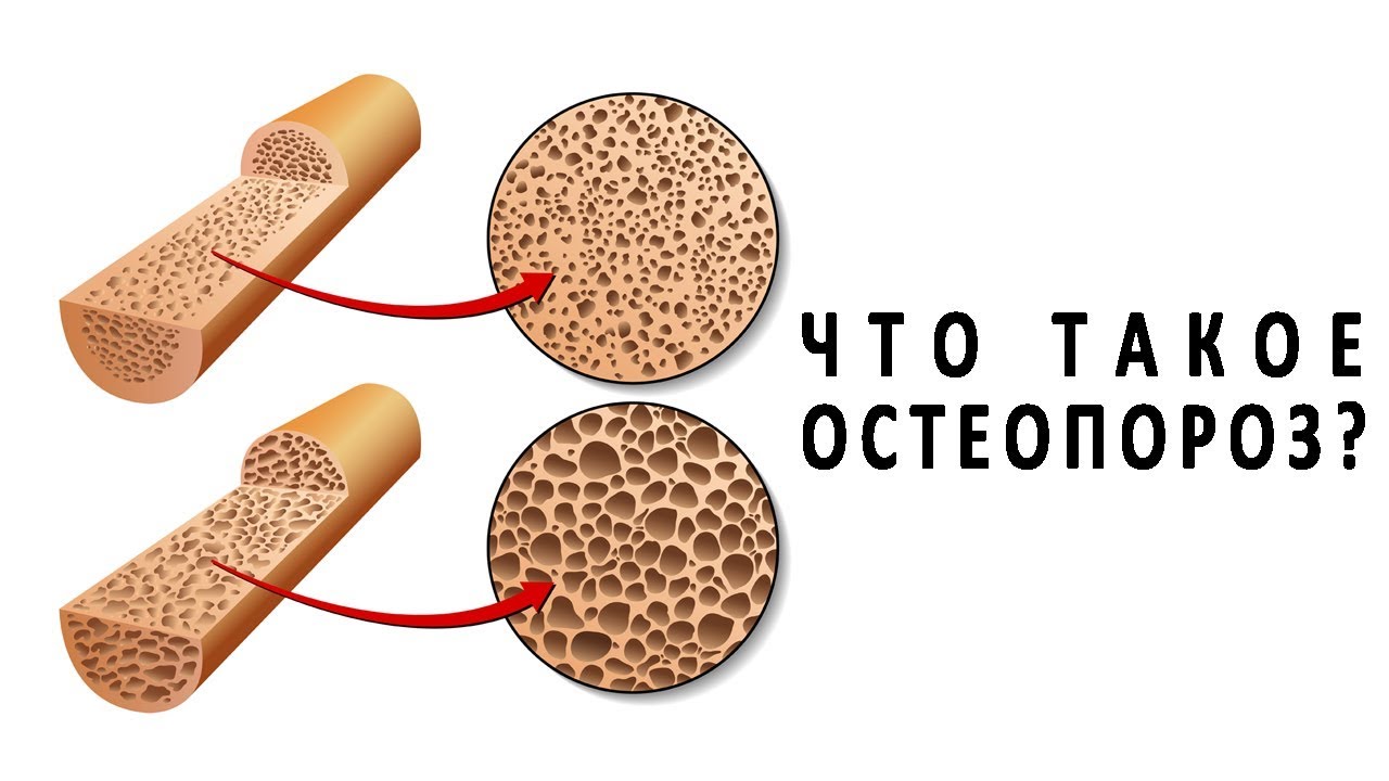 Остеопороз. Классификация. Клиника. Диагностика.