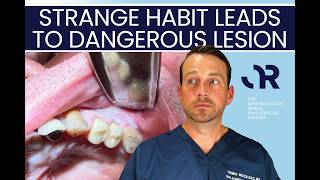 COMMON COOKING ITEM causes ORAL CANCER SCARE