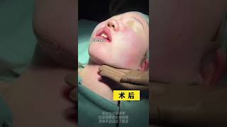 下颌缘术后即刻效果 #吸脂 #liposuction #trending #plasticsurgery #shaping #手术室日常 #fyp #塑形
