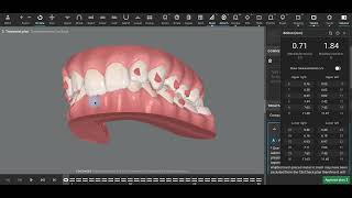 Deep Bite Sagittal Discrepancy