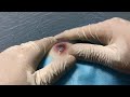 Big Cystic Acne Blackheads Extraction Blackheads & Milia, Whiteheads Removal Pimple Popping