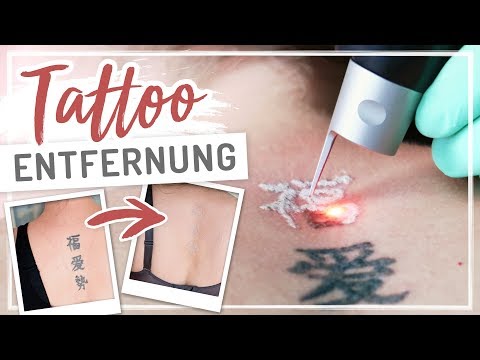 Video: Tattooentfernungscreme: Funktioniert Es Wirklich? Plus Andere Entfernungsmethoden
