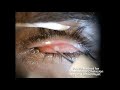 Chalazion by PLEXR Plasma