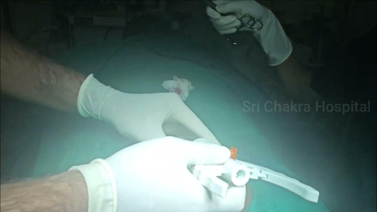 ZSR stapler Circumcision phimosis foreskin removal surgery Procedure udumalpet Step By Step 42/