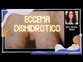 ¿Qué son las bombitas de agua que salen en la piel? ECCEMA DISHIDRÓTICO 💧💦 DISHIDROSIS