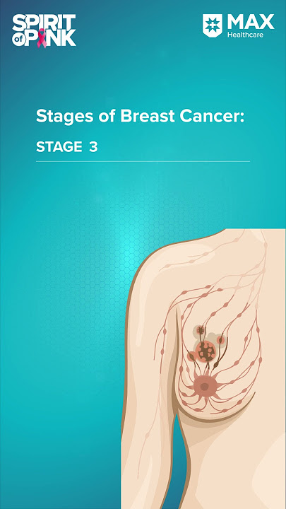 Stages of Breast Cancer
