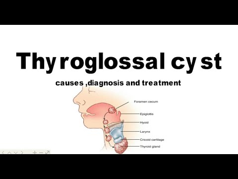 Video: Thyroglossal Ortakio Cista: Chirurgija, Gydymas Ir Simptomai