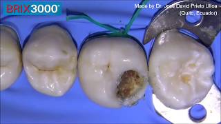 Caries removal with Brix 3000 enzymatic gel.