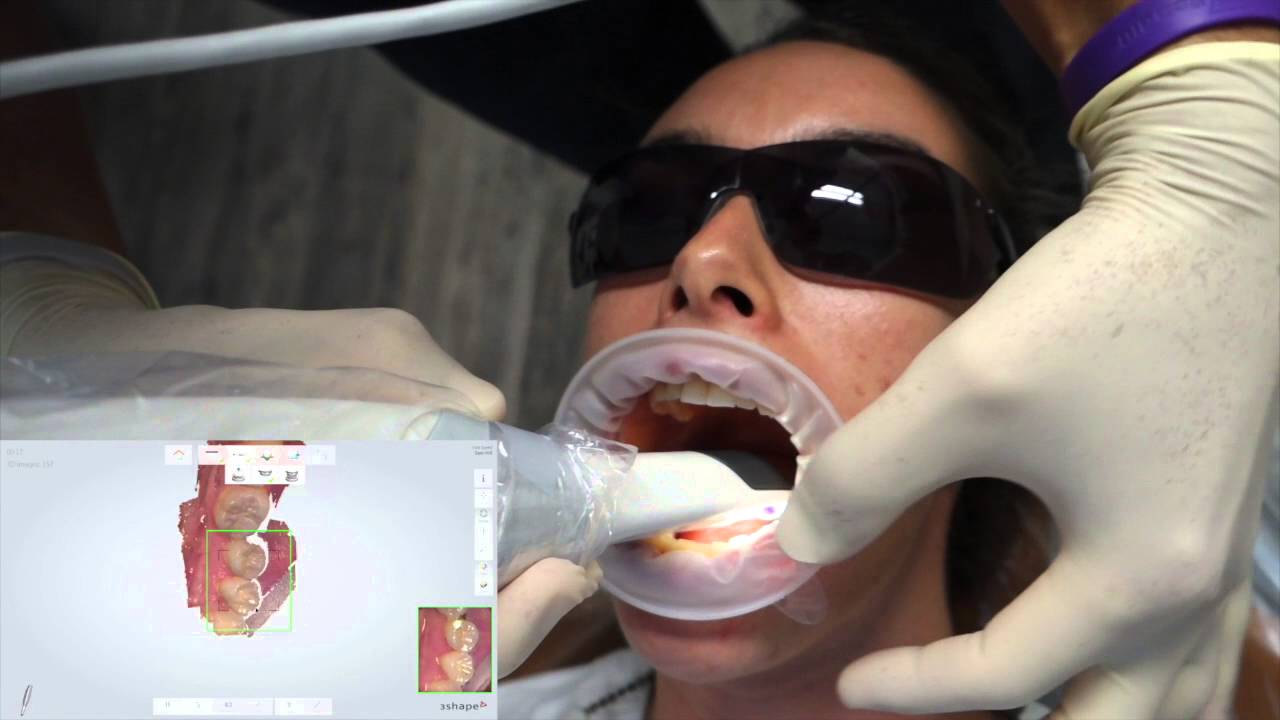 Trios 3 Shape training video - the full arch. A real dentist's guide to digital scanning. #1 of 2