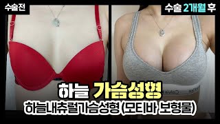 [부산 가슴성형] 내가 이 구역의 ?HOT? girl,,? 하늘 내츄럴 가슴성형(모티바 보형물) 2개월간의 변화과정✨ | 부산성형외과