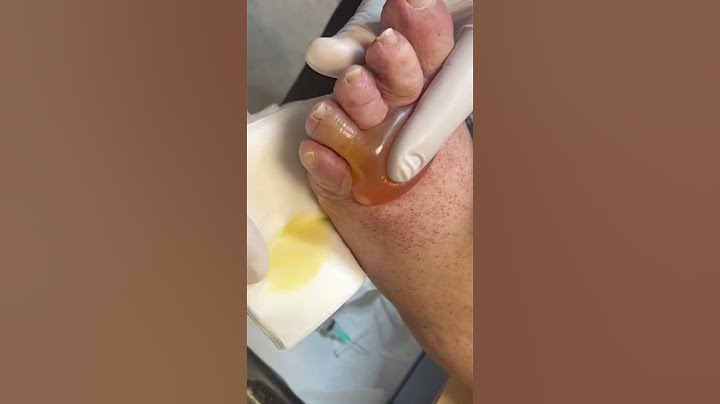 Chemotherapy induced blister drainage! #medical