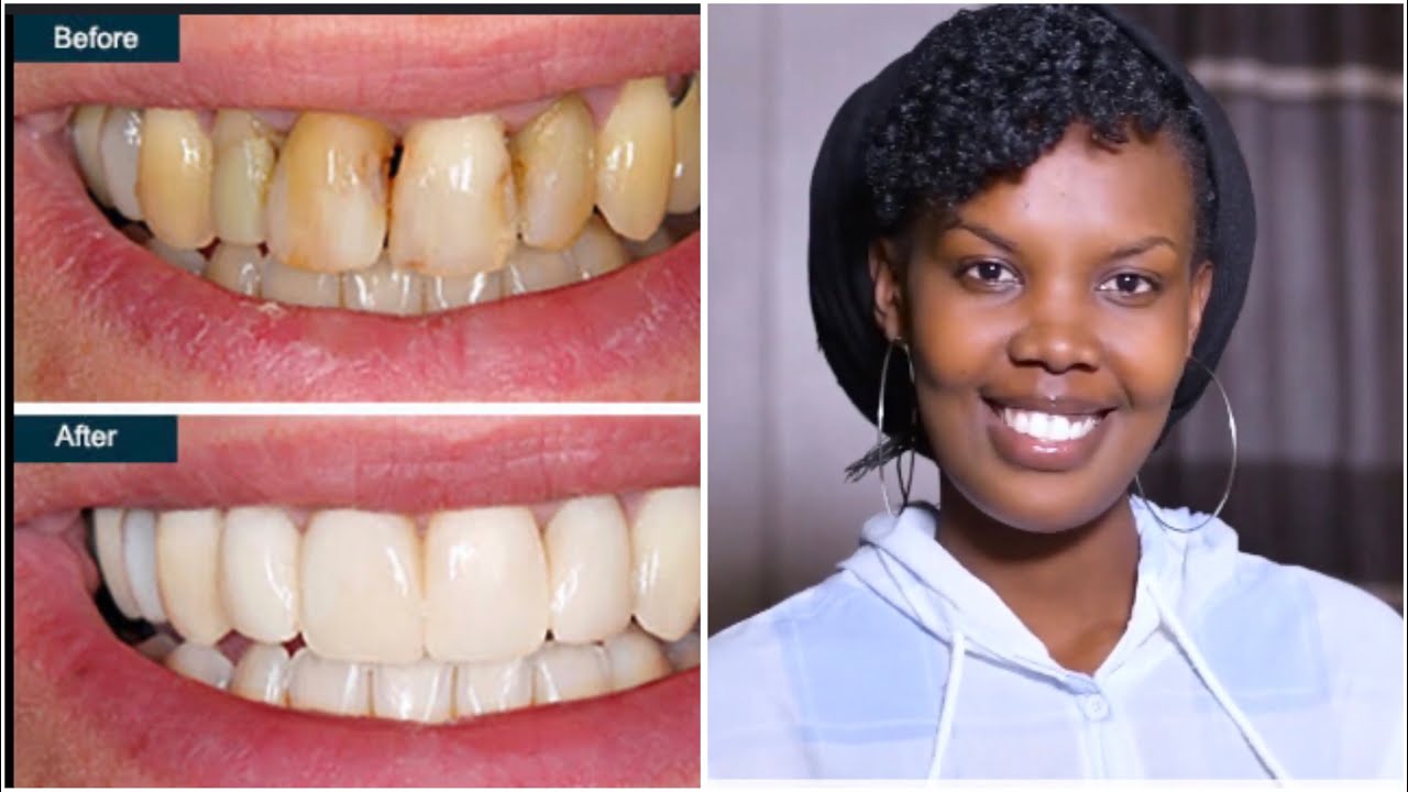 EP 06:✨Muminsi 2 gusa amenyo yawe aba ahindutse umweru🤗/kora ibi ucane ukubiri namenyo yumuhondo🥳