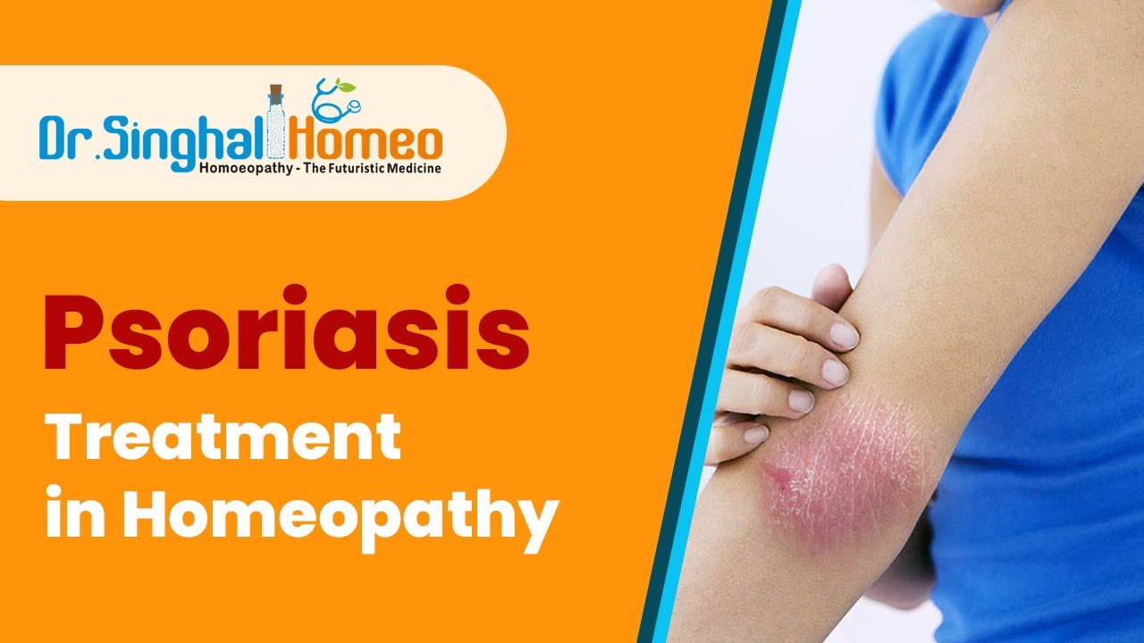 Homeopathic Treatment for Psoriasis - Dr. Singhal Homeo - YouTube