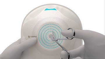 Instructie SenSura® Mio Convex Flip 1 delig Urostoma